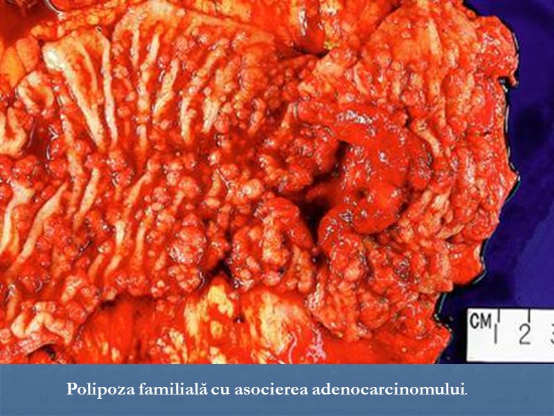 Polipoza familială cu asocierea adenocarcinomului.